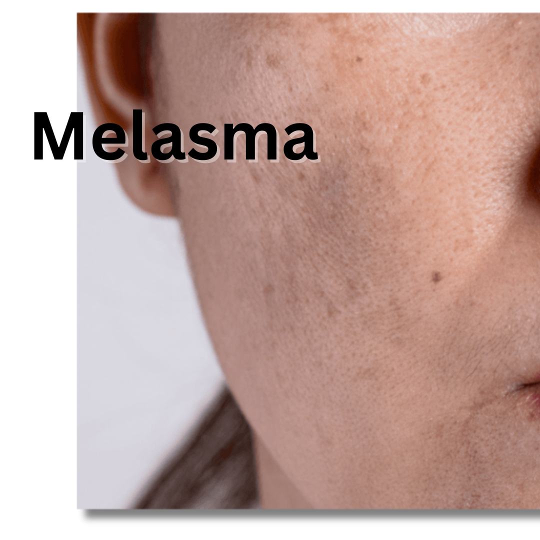 Manejo del Melasma en la Oficina de Farmacia Inicia 30 de Abril